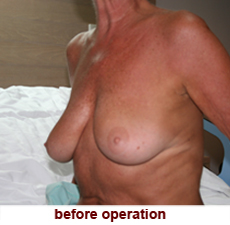 plastic-surgery-breast-lift